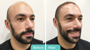 PRF Hair Restoration
