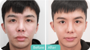 PRF Skin Rejuvenation