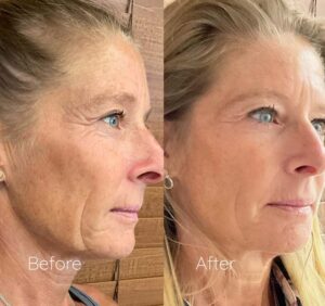 before-after-platelet rich fibrin therapy